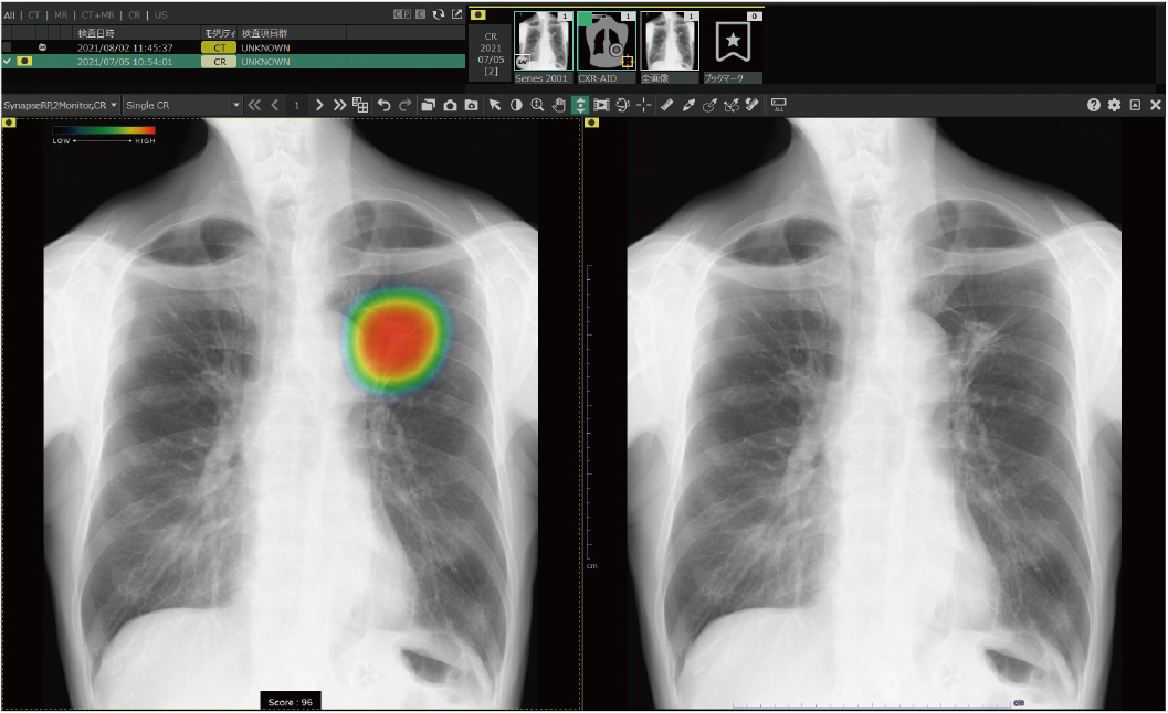 胸部X線のイメージ写真